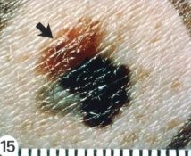 The Seven Different Types of Melanoma Skin Cancer