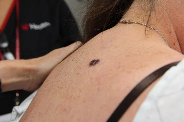 superficial spreading malignant melanoma